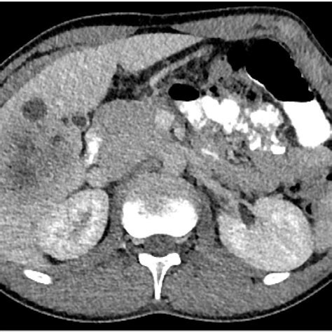 Axial Ct Image Demonstrates An Ill Defined Heterogeneous Mass In The