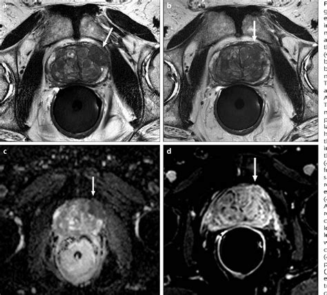 Figure 4 From Local Staging Of Prostate Cancer With Mri Semantic Scholar