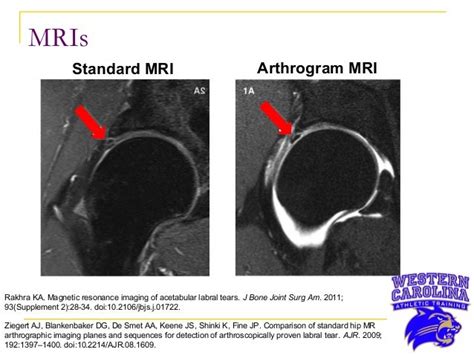 Labral Tear Hip Mri Images