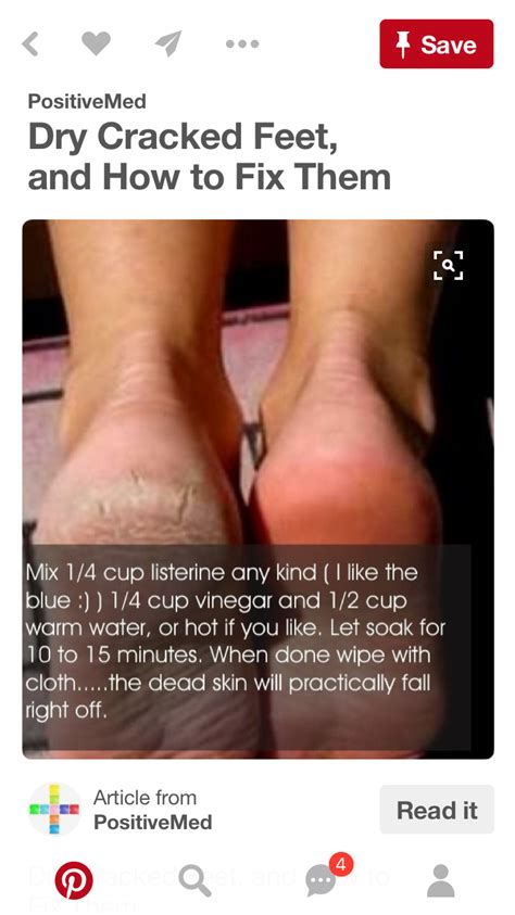 Home Remedies Health Image By Shelby Goldfarb Dry Cracked Feet Diy
