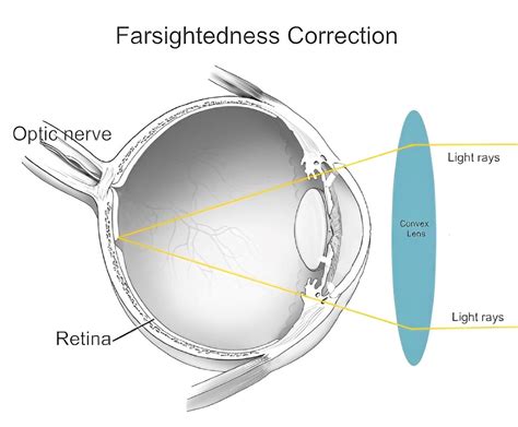 Can Farsightedness Be Corrected With Glasses