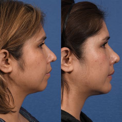 Rhinoplasty And Chin Before And After 1