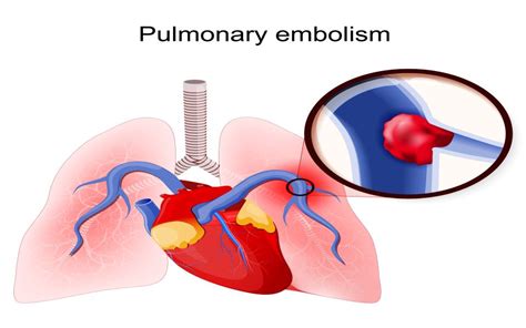 What Is Pulmonary Embolism Symptoms Risks And Treatment