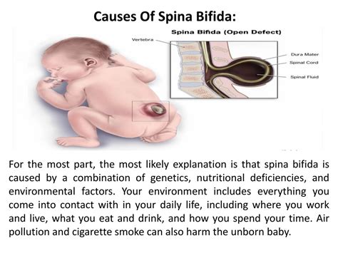PPT Dr Meher Tej AIIMS Spina Bifida Symptoms Causes Types