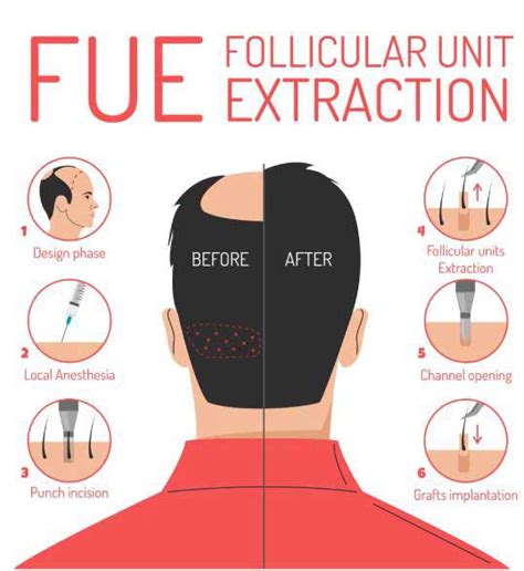 FUE Hair Transplant Los Angeles Cost In Nuance Plastic Surgery