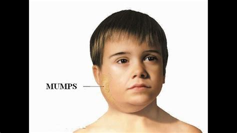 Biggest Mumps Outbreak In 22 Years Occurring In Texas
