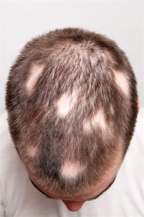 Scalp Micropigmentation For Bald Spots Smp Georgia