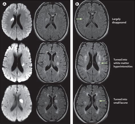 Mechanisms Of Sporadic Cerebral Small Vessel Disease Insights From