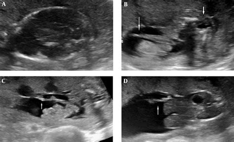 Ultrasound Images Of Amniotic Band Syndrome And A Lumbosacral