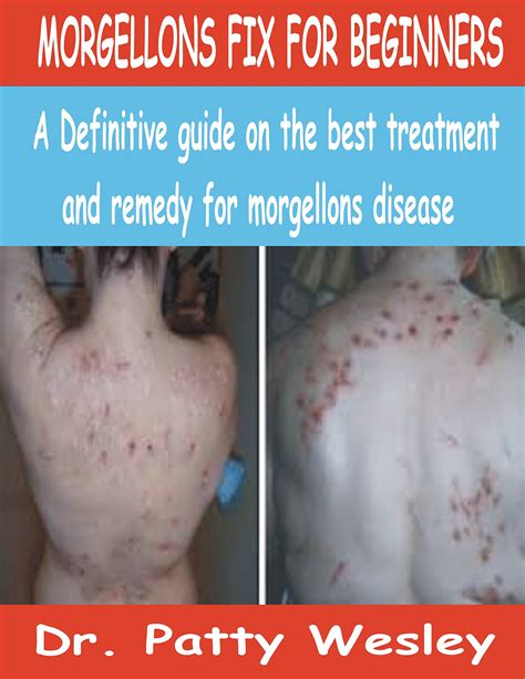 Morgellons Fix For Beginners A Definitive Guide On The Best Treatment And Remedy For Morgellons