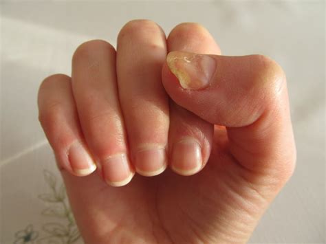 Explainer Why Do We Get Fungal Nail Infections And How Can We Treat Them