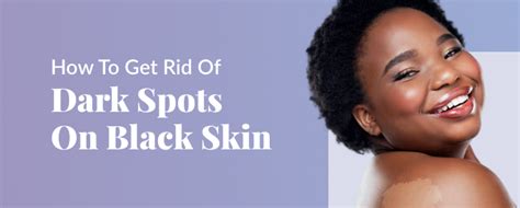How To Get Rid Of Dark Spots On Black Skin