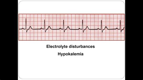 Ecg Ion Abnormalities Hypokalemia 2018 Youtube