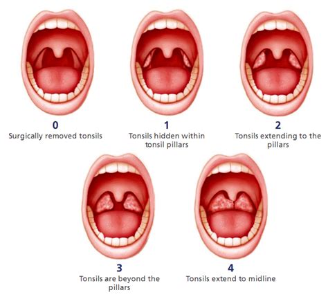 Tonsillectomy Eos Wellness