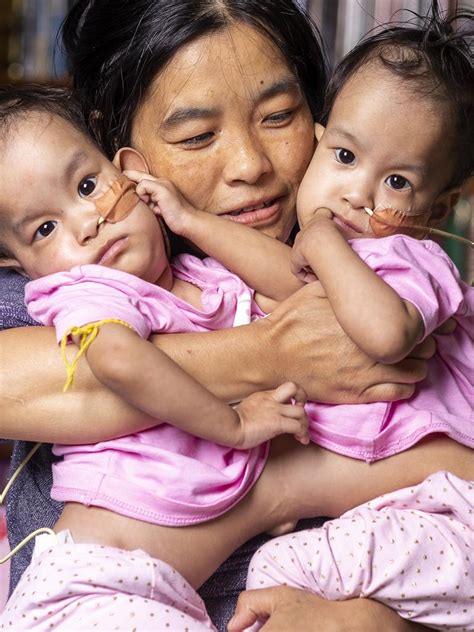 conjoined bhutanese twins undergo separation surgery in melbourne