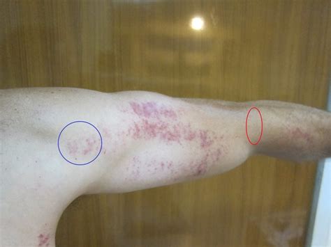 Bicep And Armpit Pain