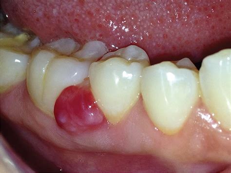 Scielo Brasil Peripheral Odontogenic Fibroma In The Mandibular