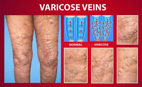 The Varicose Veins On A Legs Of Woman Stock Photo Image Of Health