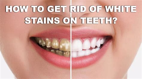 How To Get Rid Of White Stains On Teeth With Home Remedies Get Rid Of