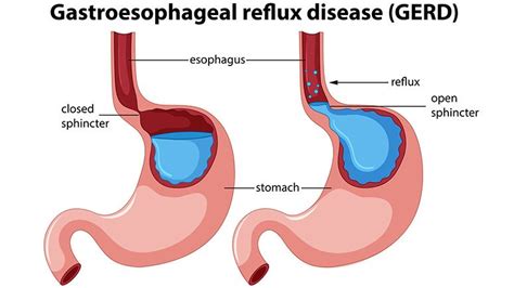 Esophageal Spasms Symptoms And Causes Page 2 Entirely Health