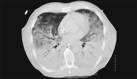 Acute respiratory distress syndrome (ards) usually affects people who are being treated for another serious illness or those who have had major injuries. Akutes Lungenversagen - Schwerpunkt ARDS Syndrom ...