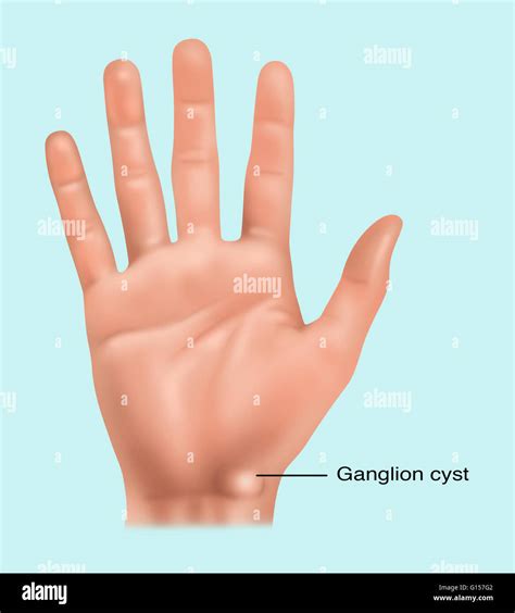 Illustration Showing A Ganglion Cyst Fluid Filled Sac In The Wrist