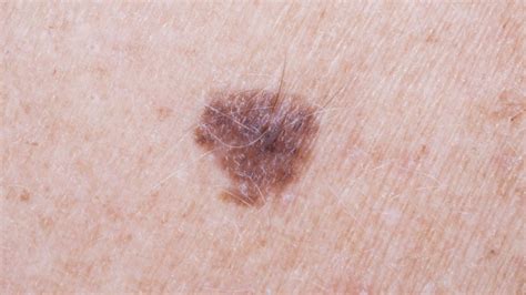 Arm Mole Count Predicts Skin Cancer Risk Bbc News