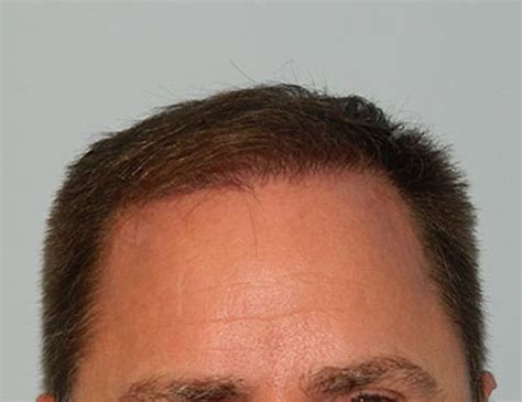 Patient 133066242 Hair Transplant Smartgraft Before And After Photos