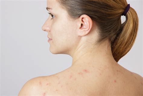 Shoulder Acne Causes And Treatment Options Emedihealth