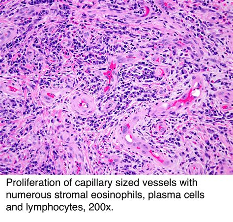 Capillary Hemangioma Lip Pathology Outlines