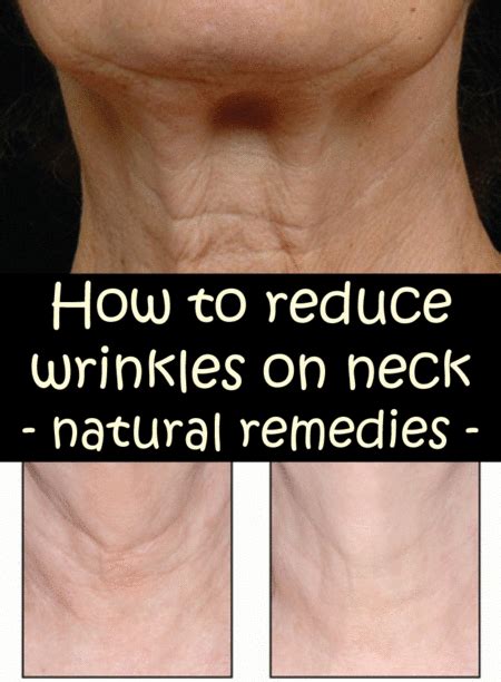 How To Reduce Wrinkles On Neck Neck Wrinkles Reduce Wrinkles Diy Anti
