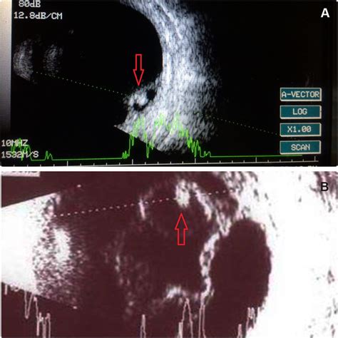 Ultrasound B Scan An Indispensable Tool For Diagnosing Ocular