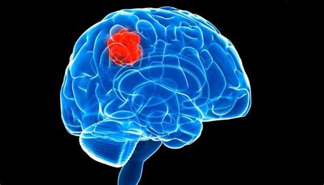 Brain tumors may be primary tumors, in which case they originate in the brain or secondary tumors that have spread to the brain from cancer elsewhere the tumor grows slowly and does not usually spread. Basics of Brain Tumors | Johns Hopkins Medicine