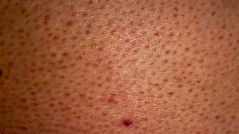 Bump Chicken Skin Back To The Coop How To Treat Keratosis Pilaris
