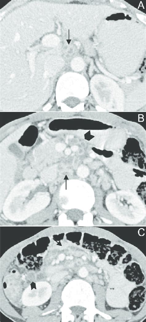 Contrast Enhanced Ct Scans In 39 Year Old Male With Abdominal