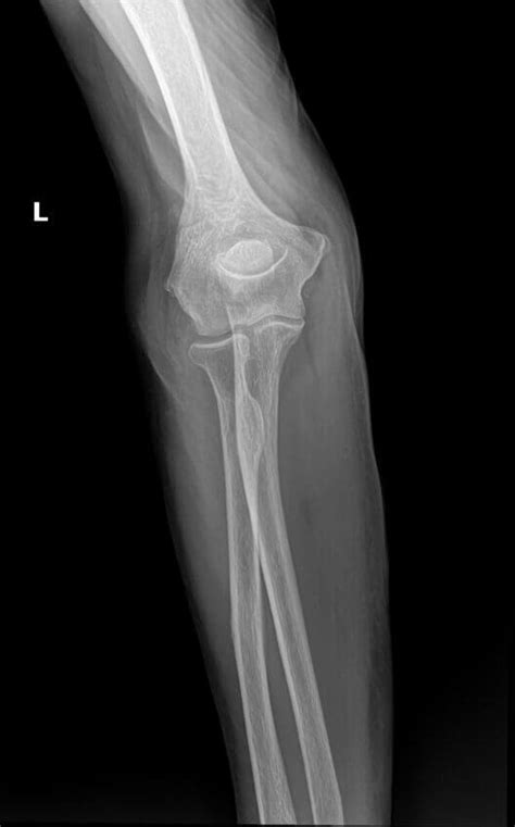 Orthodx Olecranon Fracture In Older Woman Clinical Advisor