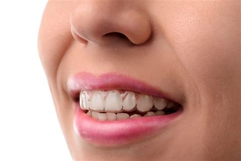 Invisalign On Your Top Teeth Only Can Be More Complicated Than It First