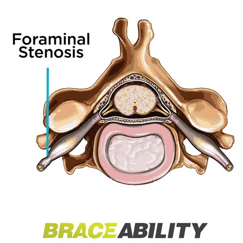 The Difference Between Foraminal Central And Lateral Recess Stenosis In