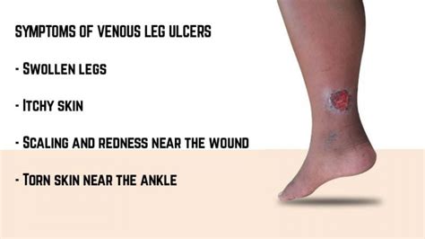 Venous Leg Ulcer Symptoms Causes And Prevention
