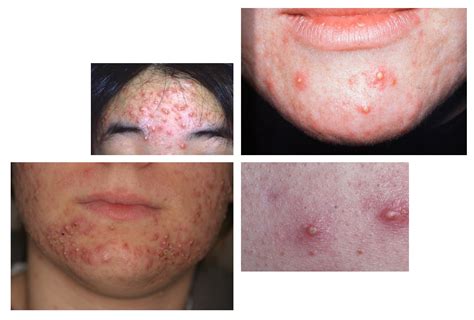Acne Types How To Recognize What Kind Of Acne You Have