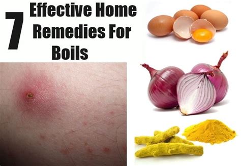 7 Effective Home Remedies For Boils Home Remedy For Boils Natural