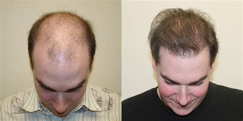 Hairline Best Dr Brett Bolton Hair Transplant Doctor In Fort