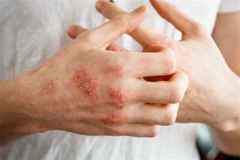 Día Mundial De La Dermatitis Atópica Murprotec