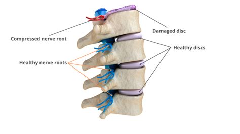 Differences Between Bulging Herniated And Prolapsed Discs