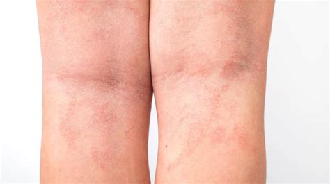 Acute Atopic Dermatitis On The Legs Behind The Knees Of A Child Is A