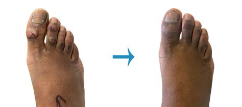 Before And After Foot Surgery Image Gallery London Foot And Ankle Surgery