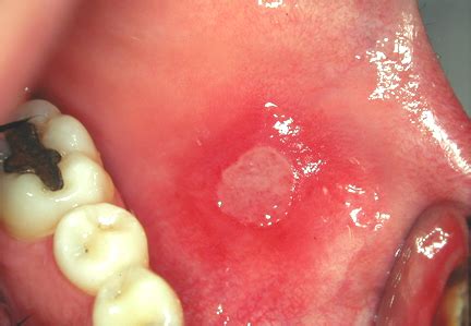 Classification Of Oral Diseases Of Hiv Associated Immune Suppression