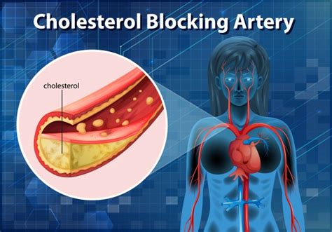 Diagram Showing Cholesterol Blocking Artery In Human Body Free Vector