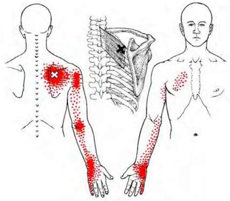 Rhomboids Trigger Point Map Backpain In 2020 Trigger Points