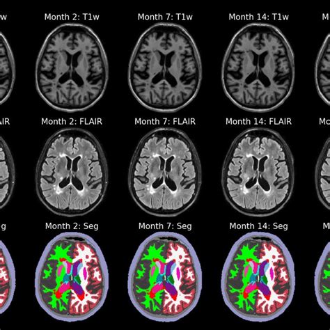 Whole Brain And White Matter Lesion Segmentations Labeled In Red